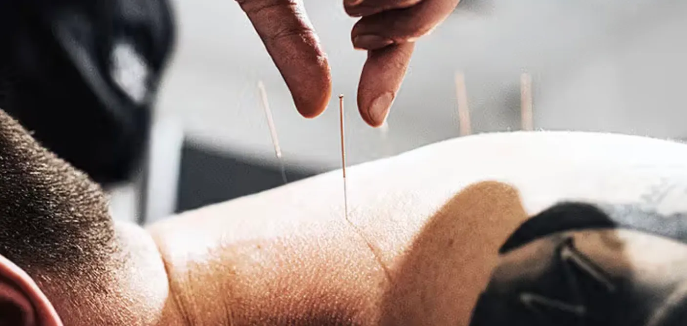Aiguilles d’acupuncture posées sur l’épaule d’un athlète, une main du praticien au-dessus