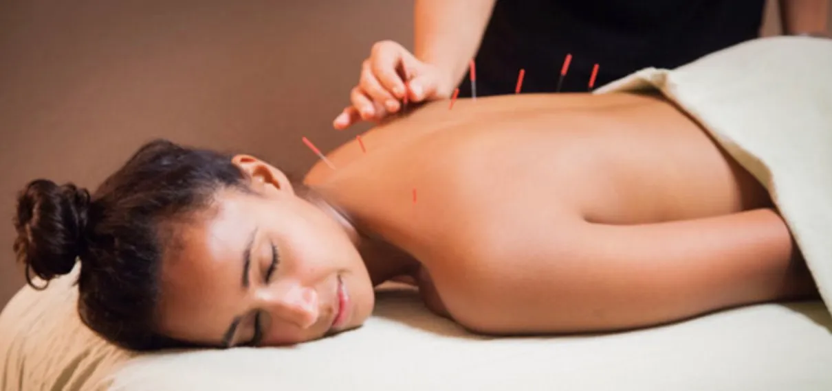 Séance d’acupuncture : aiguilles fines posées le long du dos d’une personne allongée
