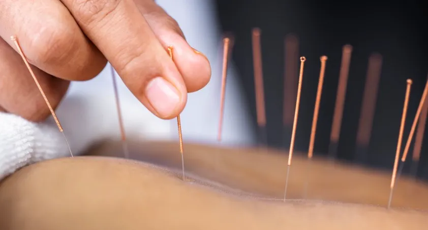 traitement du stress à Montréal, acupuncture