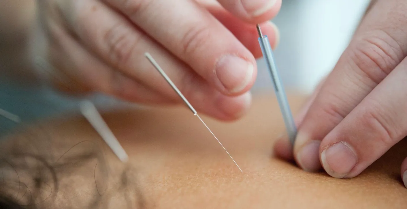 Gros plan sur les mains d'un praticien posant une aiguille d'acupuncture avec son tube guide